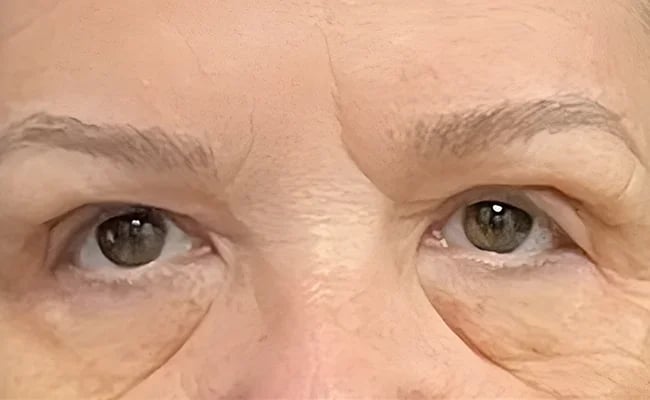 Eyelid Surgery after surgery – Murrieta Facial Plastic Surgery, case 3