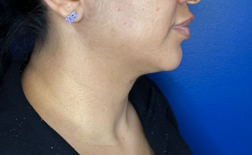 Neck Lift after surgery – Murrieta Facial Plastic Surgery, case 8