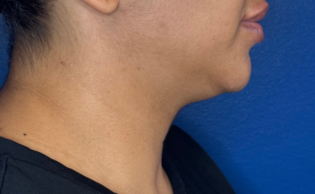 Neck Lift before surgery – Murrieta Facial Plastic Surgery, case 8