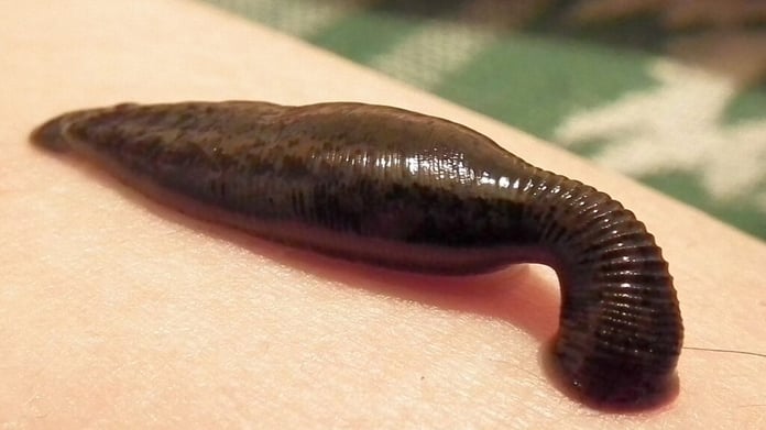 Uzmanlar uyarıyor! Sülük tedavisi nedir, ne işe yarar?