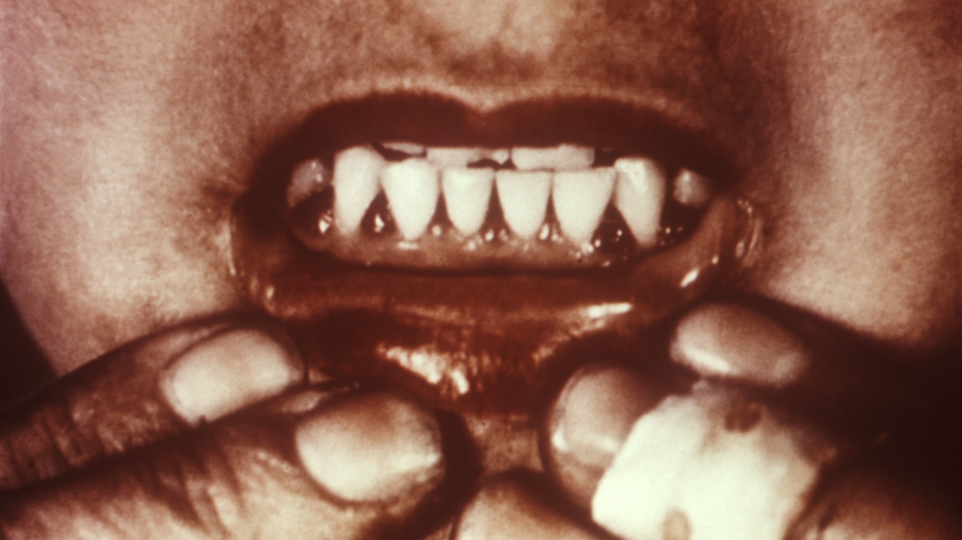 İskorbut hastalığı