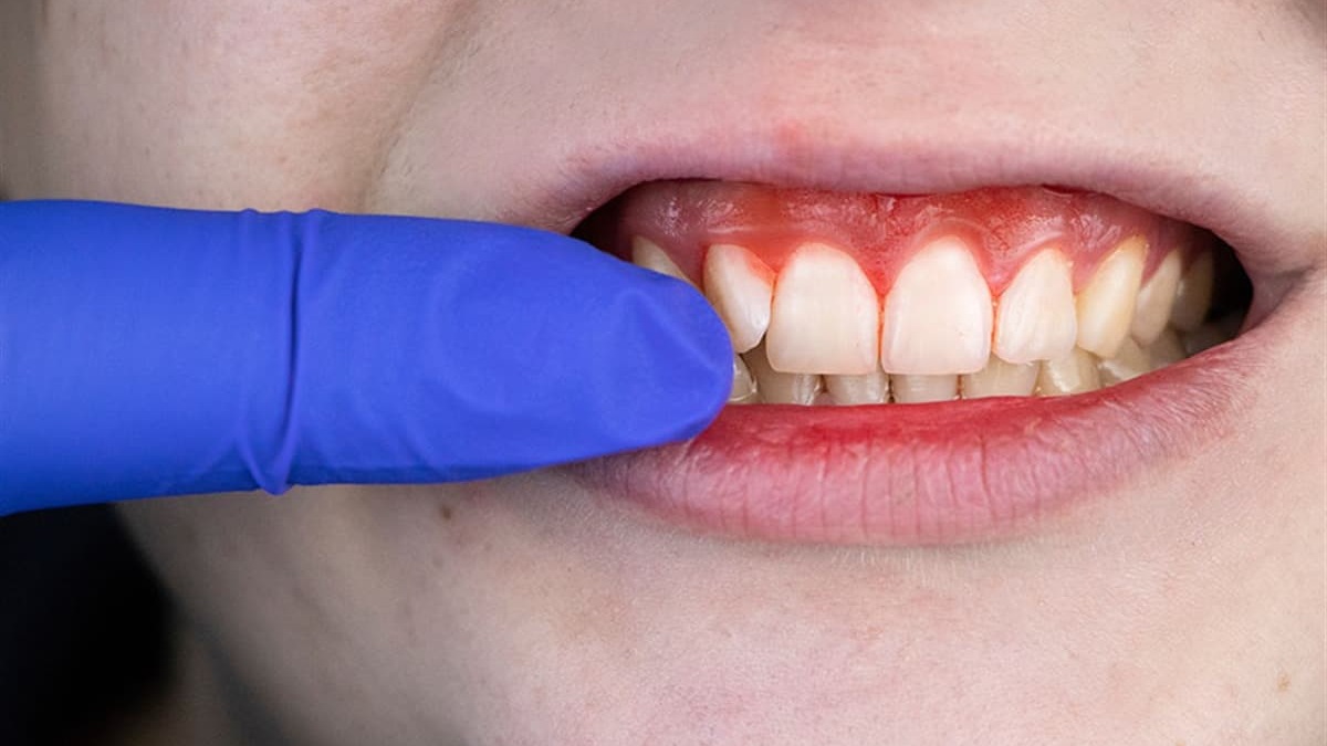 İskorbut hastalığı