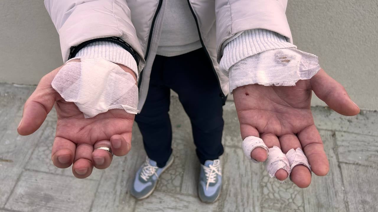 Köpeklerin saldırısından kaçarken yaralanan Selahattin Büyük ellerinden yaralandı - DHA