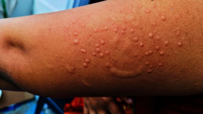 Avrupa’da ilk vaka çıktı! Maymun Çiçeği Türkiye’de görüldü mü? Mpox virüsü Türkiye’de var mı?