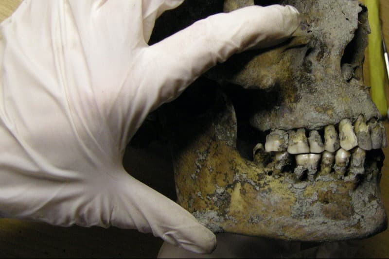 İsveç’teki Vikingler de diş çürüklerinden muzdaripti