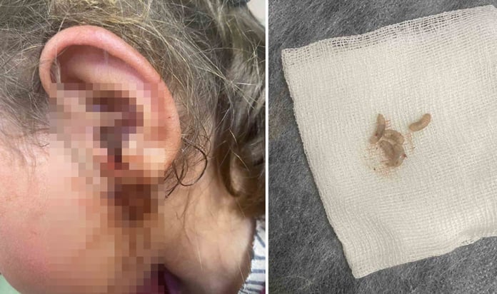 3 yaşındaki çocuğun kulağından 23 adet canlı kurtçuk çıkartıldı