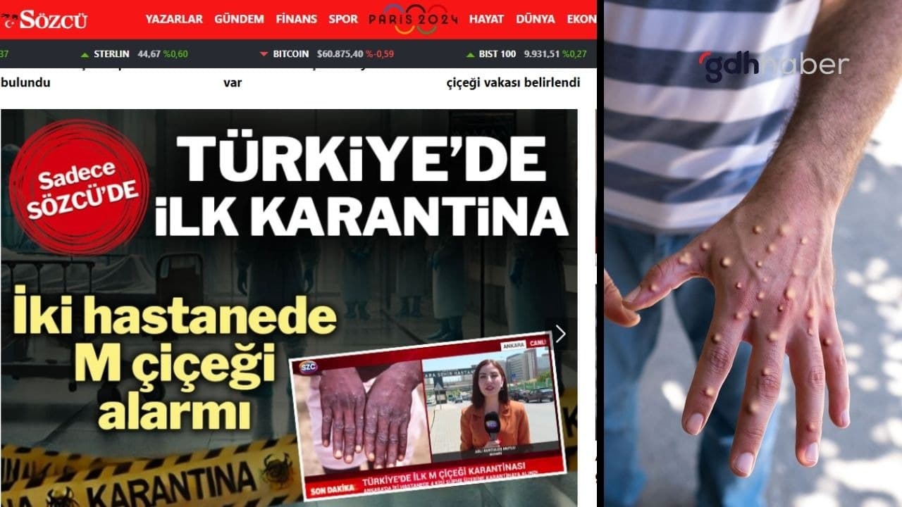 Ankara’da 4 kişi “Maymun Çiçeği” karantinası mı alındı? Sözcü’nün dezenformasyon içeren haberine DMM’den yanıt geldi!