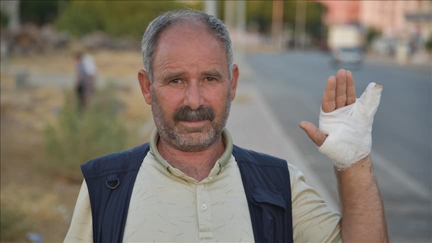 Şanlıurfa'da başıboş köpeğin saldırdığı kişi serçe parmağını kaybetme riski yaşıyor