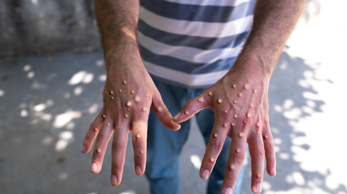 Maymun Çiçeği virüsü öldürür mü? Maymun Çiçeği virüsü Türkiye'de var mı?