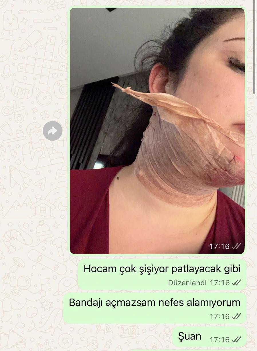 Gıdı aldırma sonrası boyun hematomu nedir