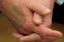 Beyaz Saray'dan Trump'ın elindeki morlukla ilgili garip açıklama