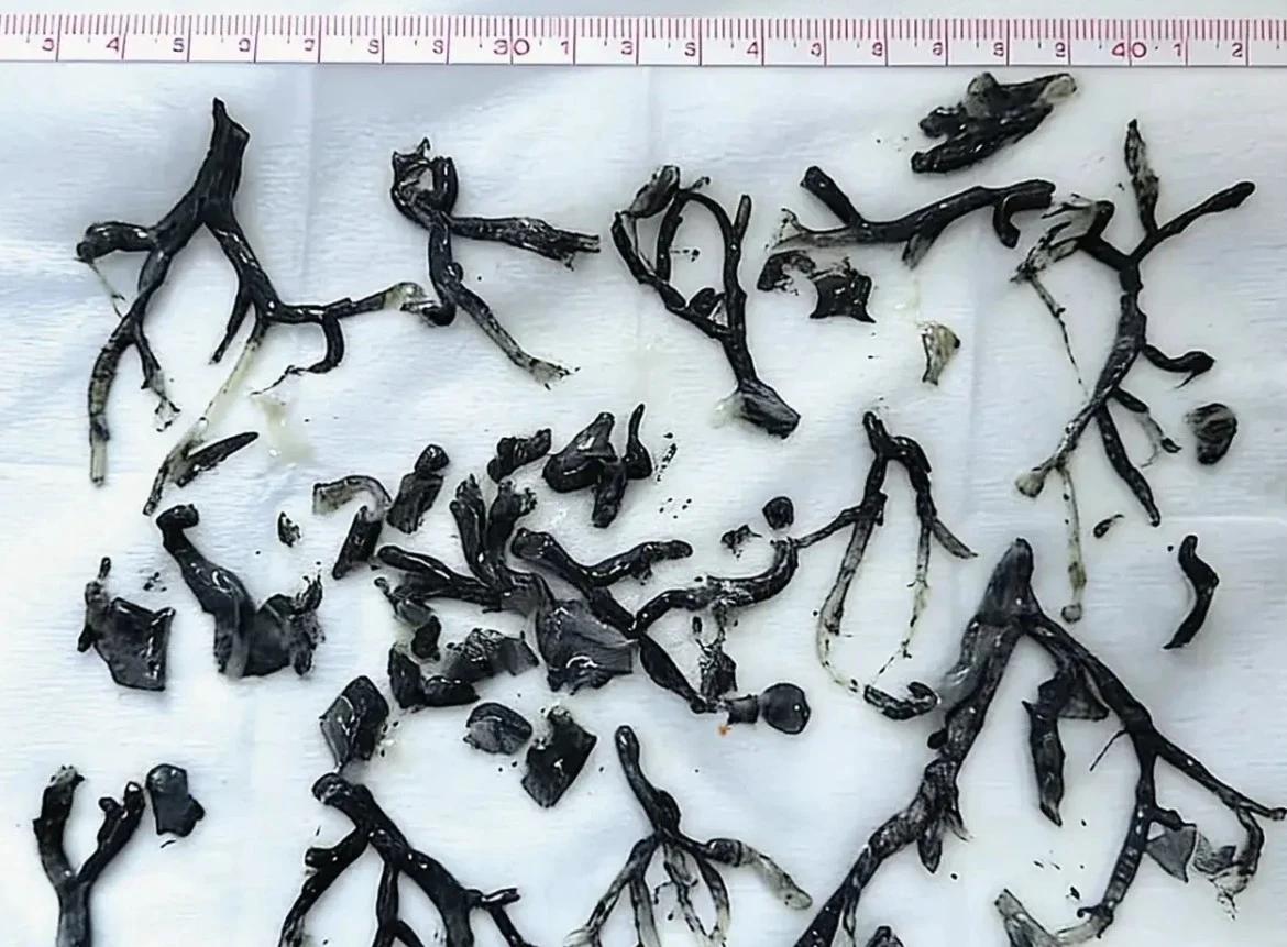Plastik bronşit vakası
