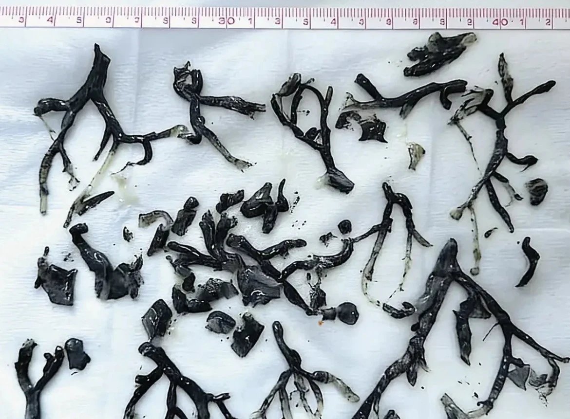 Plastik bronşit vakası