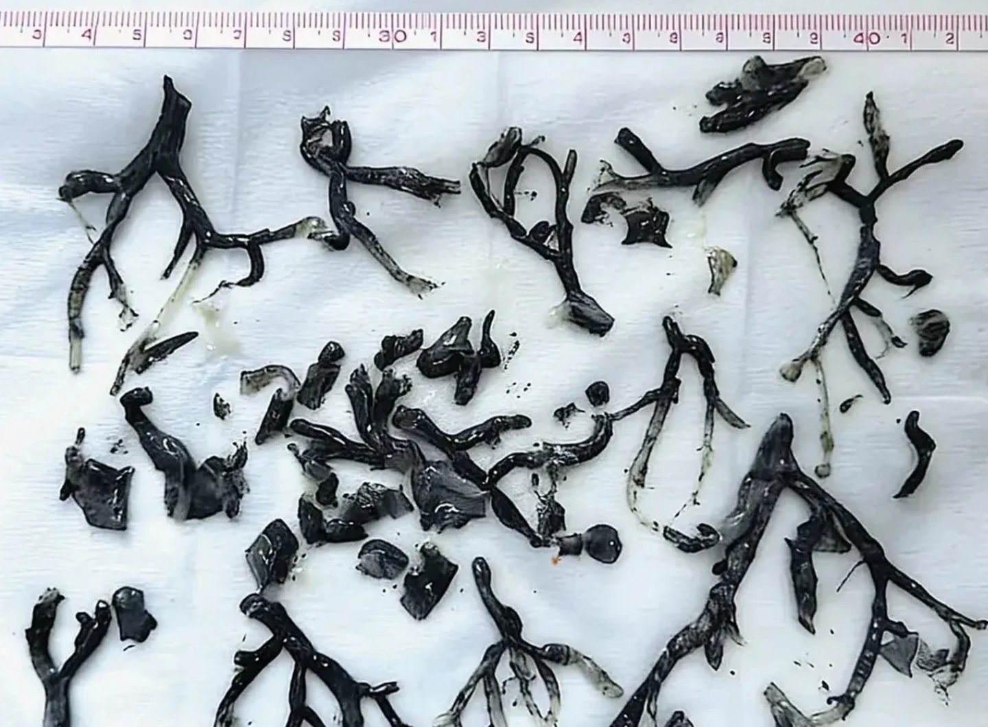 Plastik bronşit vakası