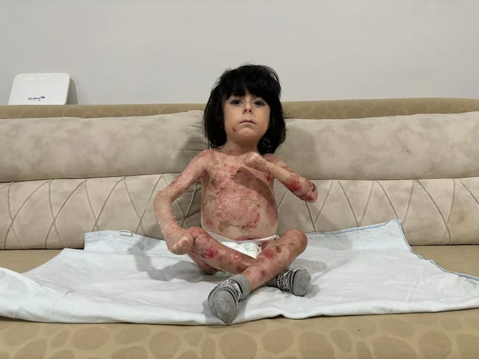 Bursa’da yürek yakan dram: Kelebek hastası minik İbrahim'in acı dolu yaşam mücadelesi