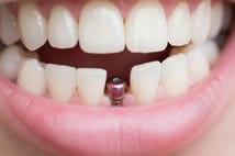 Milyonları ilgilendiriyor! İmplant tedavisine SSK desteği geliyor