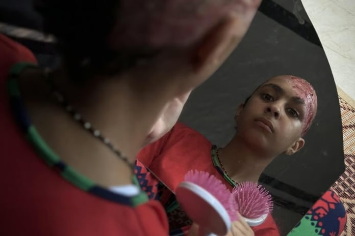 İsrail saldırılarında saçlarını kaybeden Gazzeli çocuk yardım istiyor