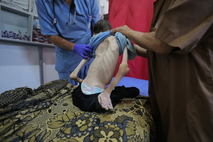 Gazze'de açlıktan ölenlerin sayısı 239'a yükseldi