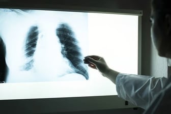 Akciğerleri bitiren sinsi tehlike: Uzmanlar uyardı!