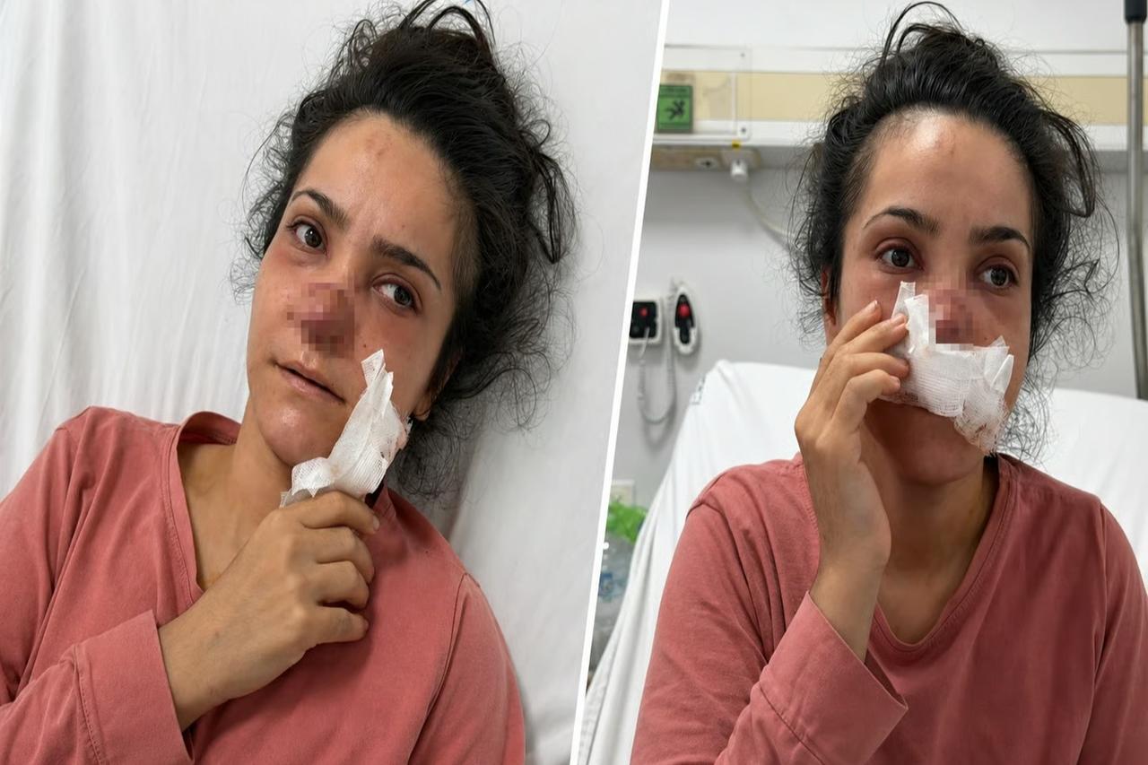 Eşi burnunu ısırarak kopartmıştı!