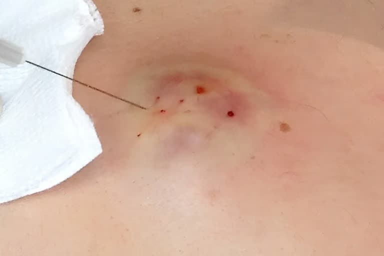 Uzman isim açıkladı: Kıl dönmesinde tekrar riskini yüzde 5'in altına düşüren öneriler