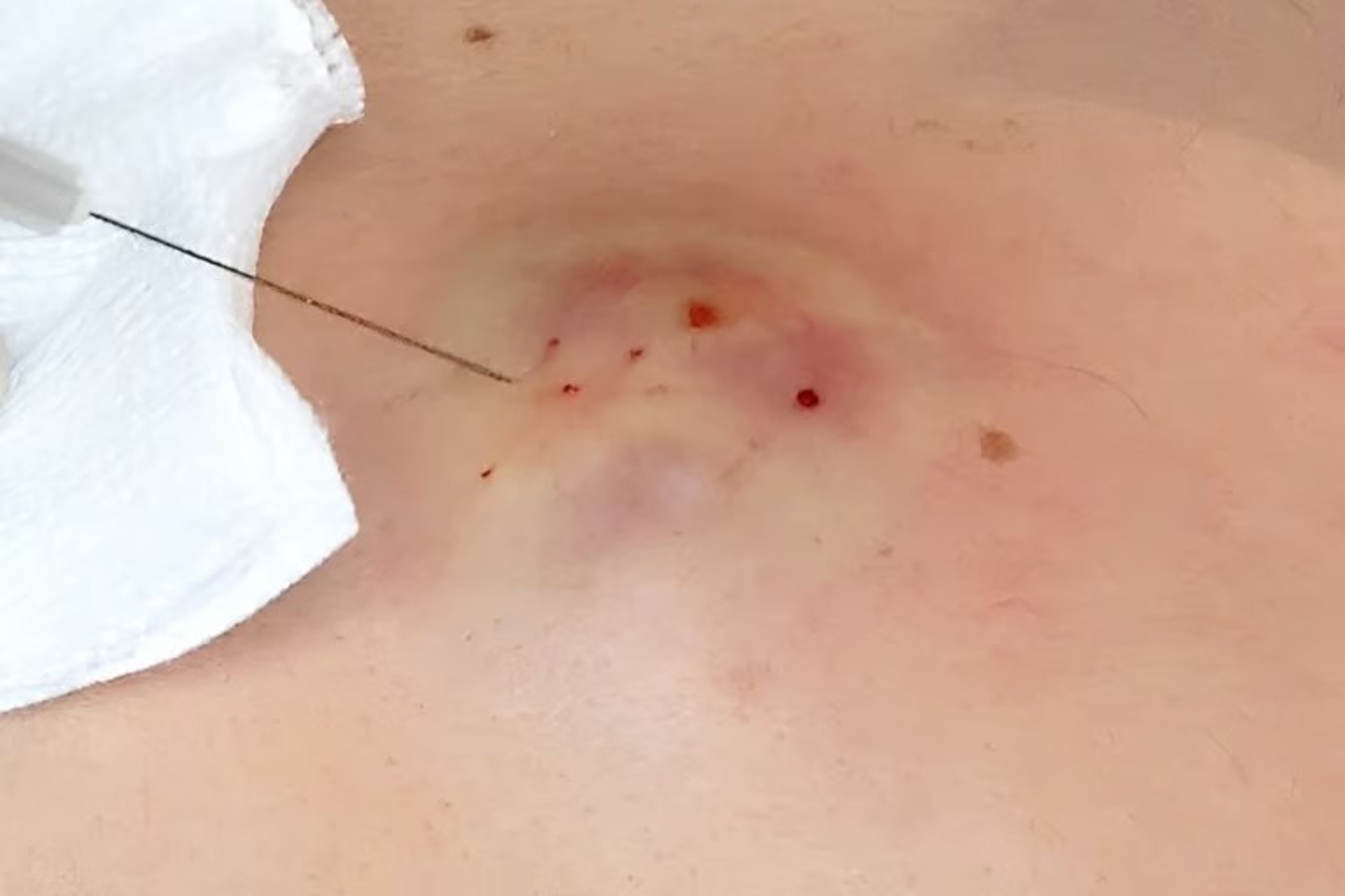 Uzman isim açıkladı: Kıl dönmesinde tekrar riskini yüzde 5'in altına düşüren öneriler