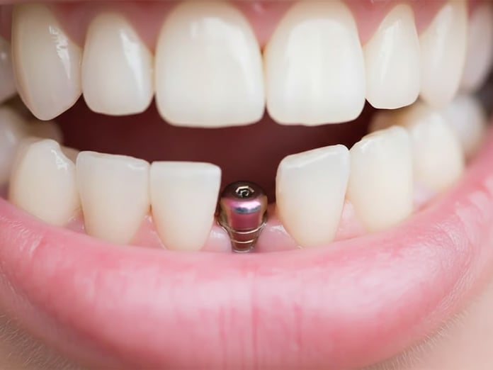 Milyonları ilgilendiriyor! İmplant tedavisine SSK desteği geliyor