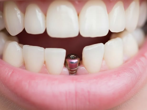 Milyonları ilgilendiriyor! İmplant tedavisine SSK desteği geliyor