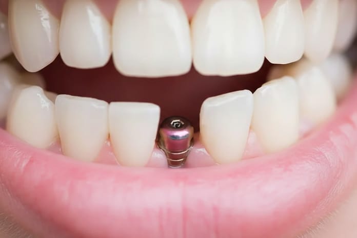 Milyonları ilgilendiriyor! İmplant tedavisine SSK desteği geliyor