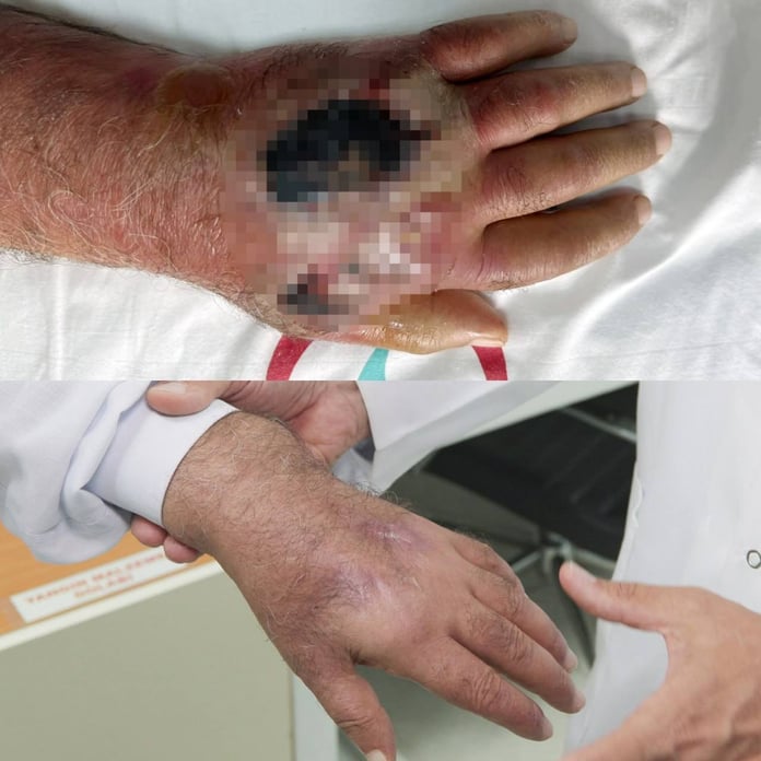 İnsan ısırığında nadir vaka: Amputasyondan kurtuldu