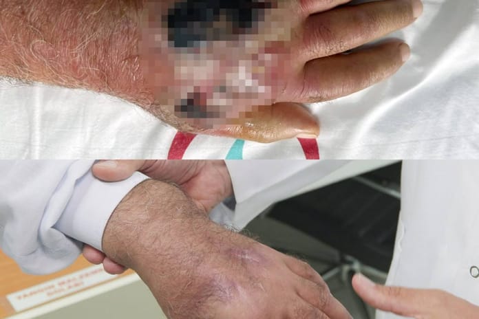 İnsan ısırığında nadir vaka: Amputasyondan kurtuldu