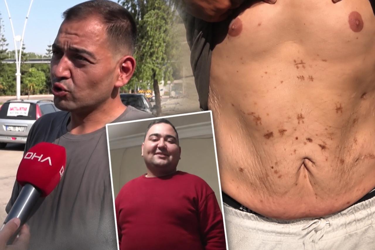 Tüp mide ameliyatı sonrası günden güne eriyor! 3 ameliyat geçirdi, yaşadıklarını böyle anlattı: “Kanlı kusuyorum”