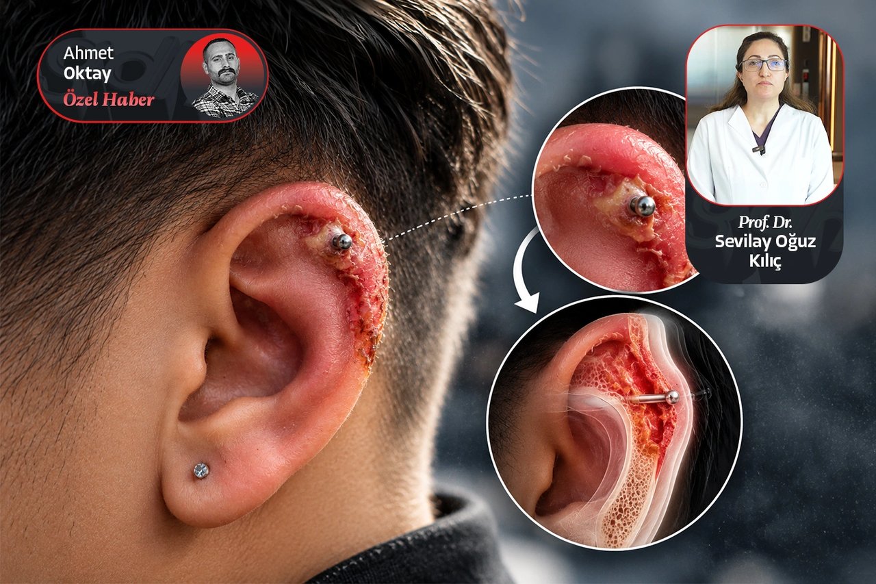 Piercing yaptırırken bir kez daha düşünün: Kıkırdak enfeksiyonları kalıcı doku kaybına yol açabiliyor