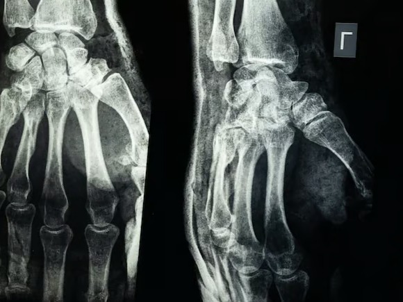 Ortopedide çığır açan buluş: 3 dakikada kırıkları onaran yapıştırıcı