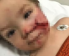 Başkentte pitbull saldırısı! 'Çocuğumun yüzüne bakamıyorum' 