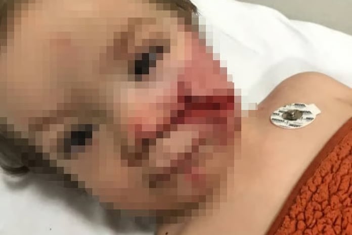 Başkentte pitbull saldırısı! 'Çocuğumun yüzüne bakamıyorum' 