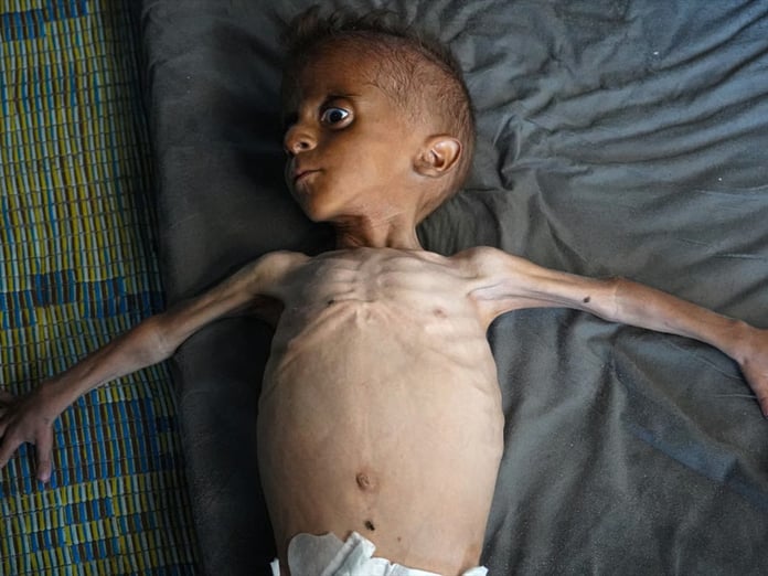 Gazze'de açlıktan ölenlerin sayısı 271'e yükseldi