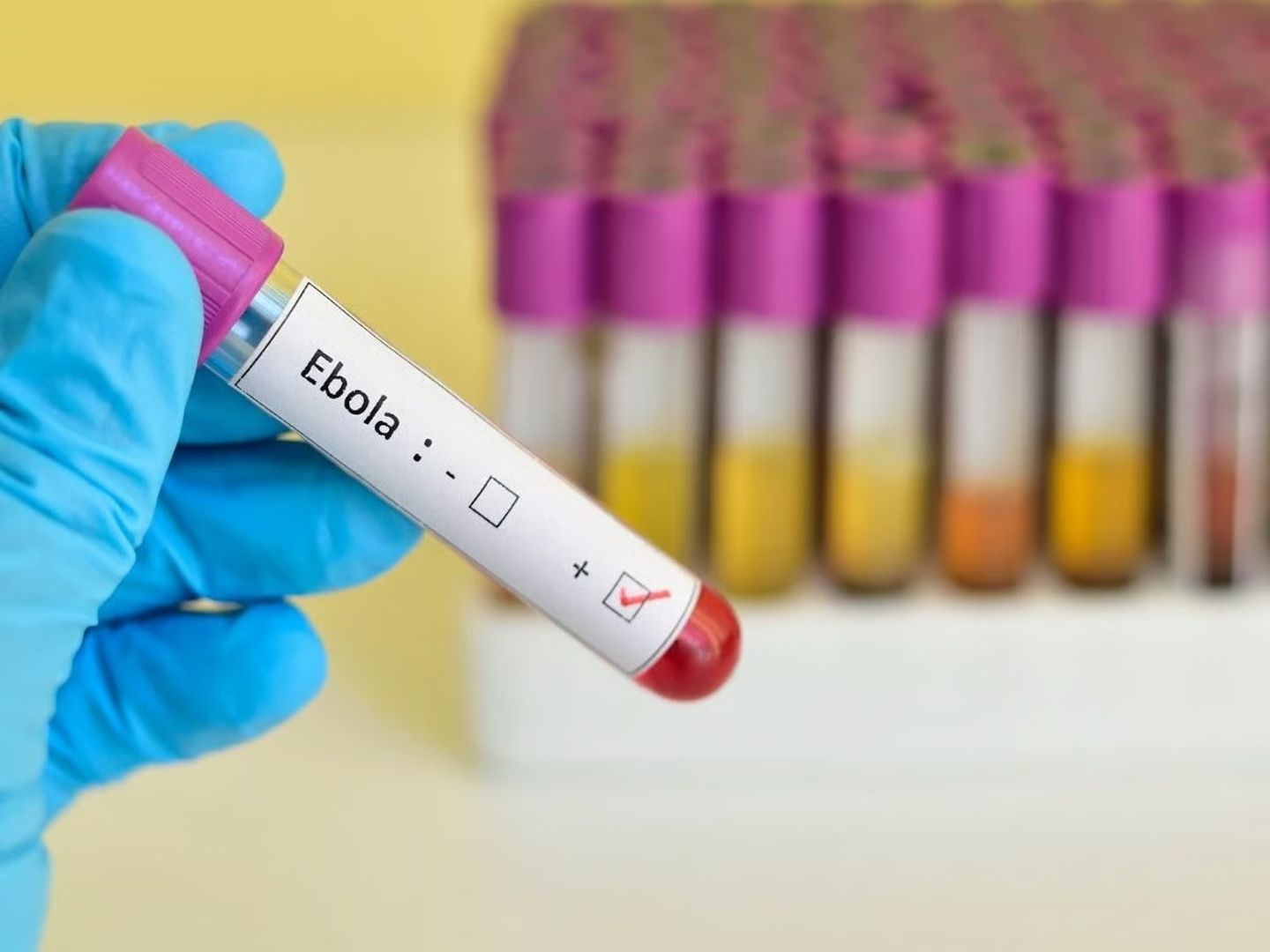 DSÖ acil durum ilan etti: "Aşısı olmayan Ebola virüsü hastalığı nedir, belirtileri neler?" sorusu gündem oldu!