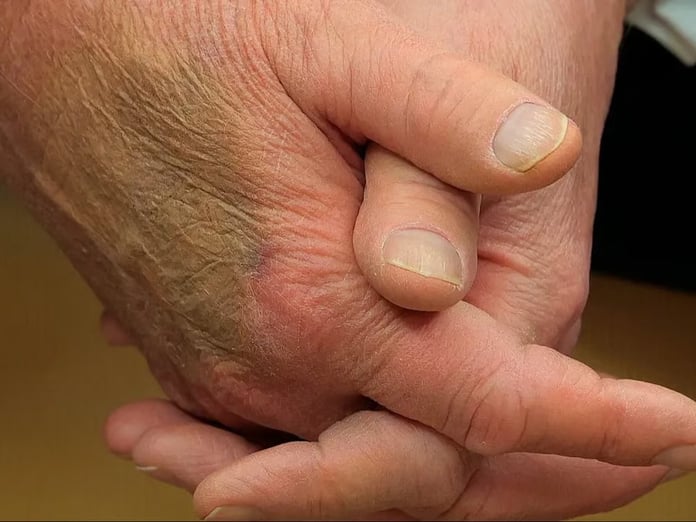 Beyaz Saray'dan Trump'ın elindeki morlukla ilgili garip açıklama