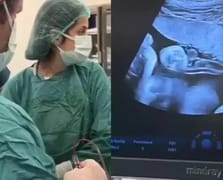 Mucize operasyon: Anne karnındaki 8 aylık bebeğe kan nakli