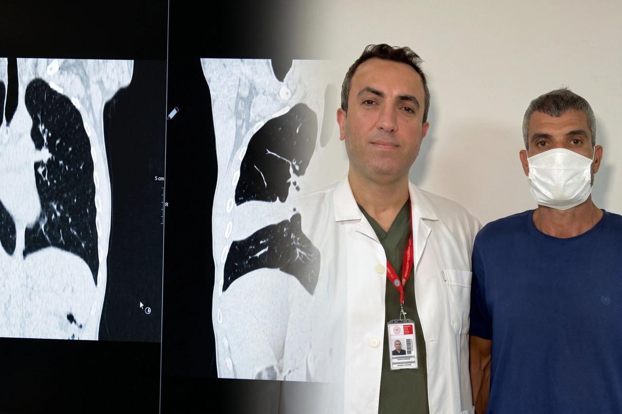 İstanbul’da hastanın akciğerinden kemik çıktı: Kemiği seven biriyim, şaşırtmadı