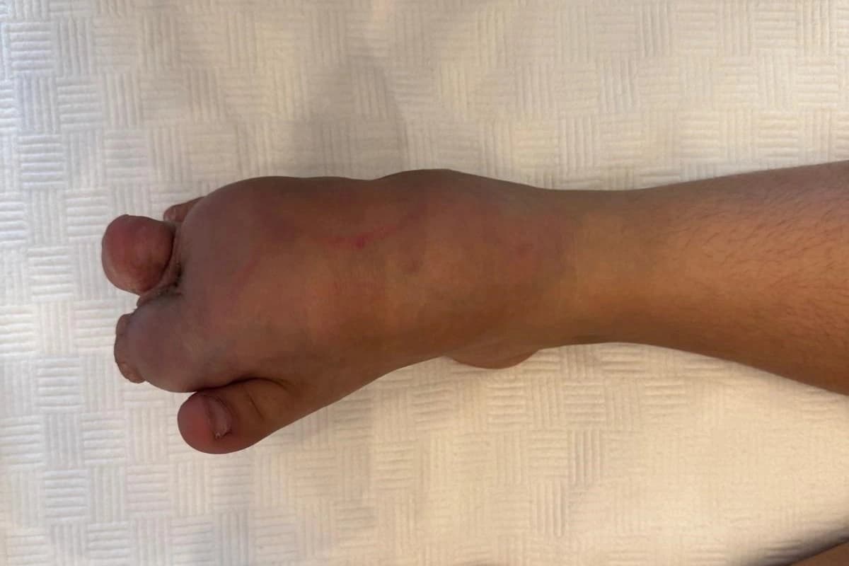 Milyonda bir görülen hastalıkla savaşıyordu: Şifayı Türkiye'de buldu