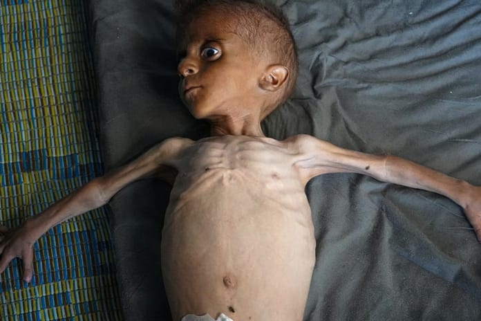 Gazze'de 8 kişi daha açlıktan hayatını kaybetti