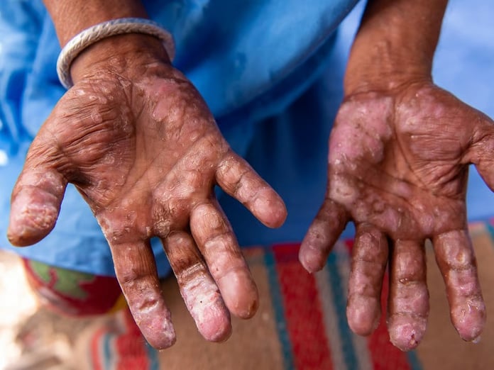 Avrupa ülkelerinde cüzzam vakaları panik yarattı