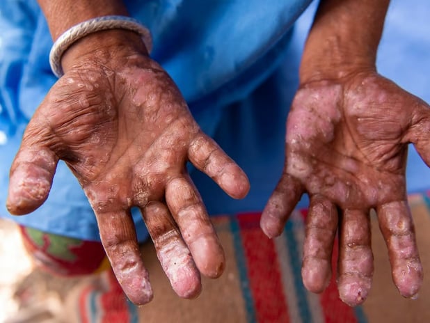 Avrupa ülkelerinde cüzzam vakaları panik yarattı