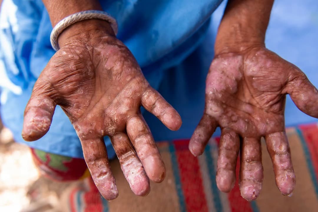 Avrupa'da 30 yıl sonra cüzzam alarmı