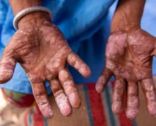 Avrupa ülkelerinde cüzzam vakaları panik yarattı