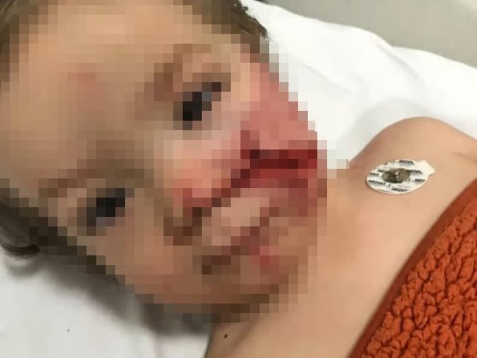 Başkentte pitbull saldırısı! 'Çocuğumun yüzüne bakamıyorum' 