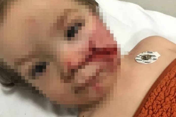 Başkentte pitbull saldırısı! 'Çocuğumun yüzüne bakamıyorum' 