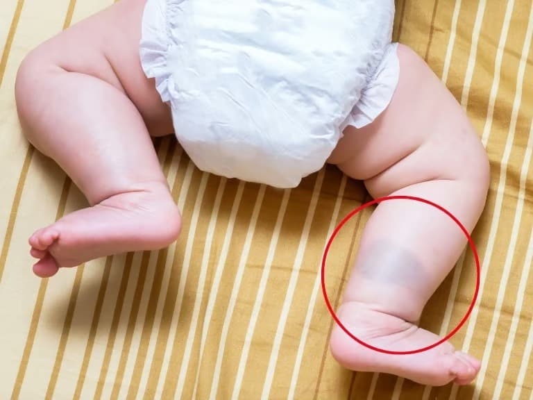 Çocuğunuzun vücudundaki kahverengi lekelere dikkat!